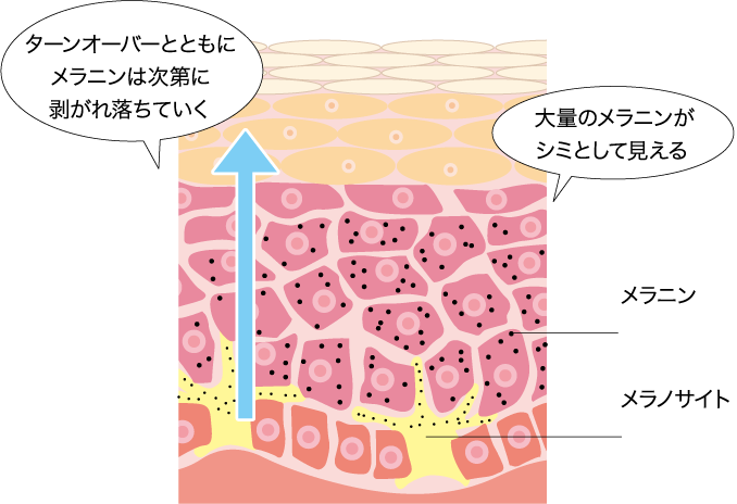 ターンオーバーとともにメラニンは次第に剥がれ落ちていく大量のメラニンがシミとして見えるメラニンメラノサイト