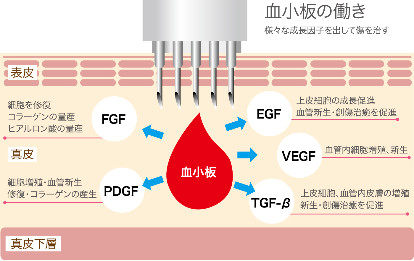 血小板の働き 様々な成長因子を出して傷を治す 表皮 細胞を修復コラーゲンの量産ヒアルロン酸の量産 FGF 真皮 細胞増殖・血管新生 修復・コラーゲンの産生 PDGF EGF 上皮細胞の成長促進血管新生・創傷治癒を促進 VEGF 血管内細胞増殖、新生 TGF-β 上皮細胞、血管内皮膚の増殖新生・創傷治癒を促進 真皮下層