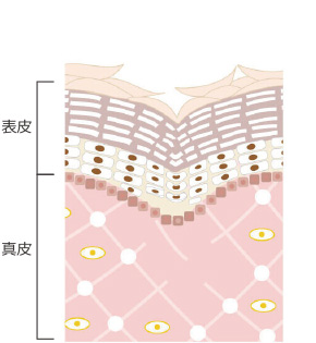 トラブルのある肌